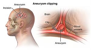 aneurysm clipping
