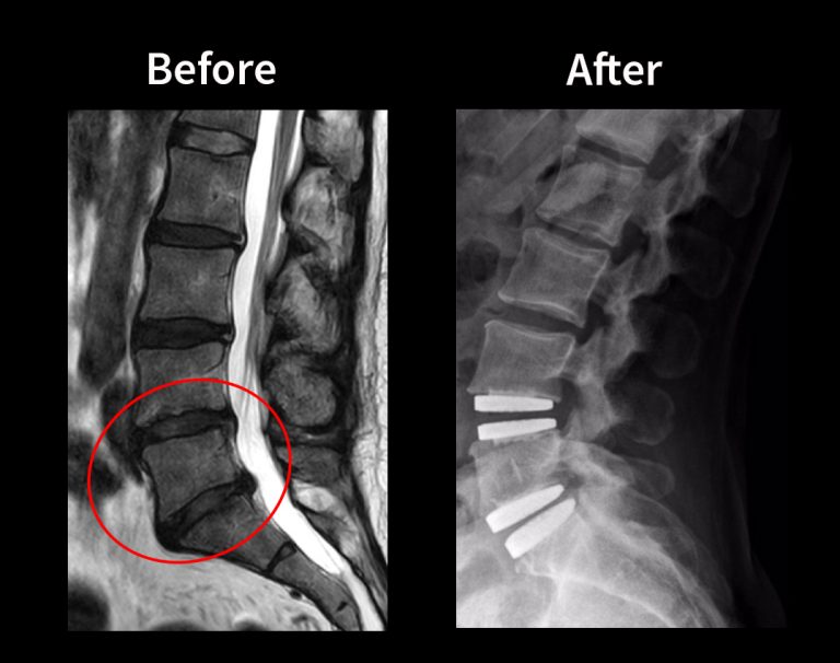 disc replacement surgery before and after
